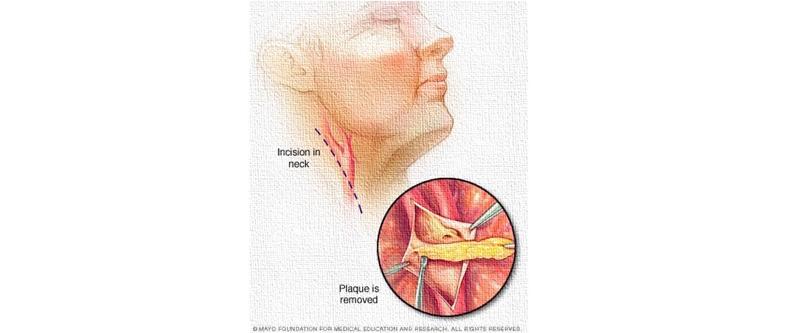 Carotid artery disease: Endarterectomy 