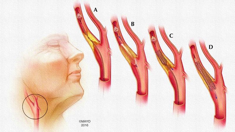 Carotid Artery Disease: Stenting