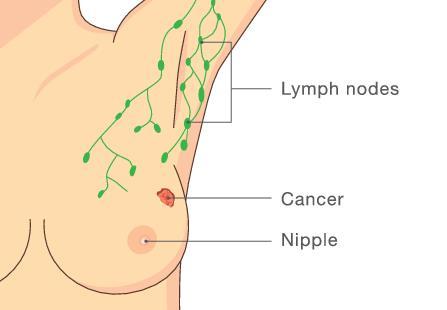 Breast Cancer Lymphnodes