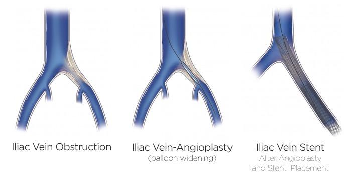 Venous Thrombosis: Venoplasty - Stenting 