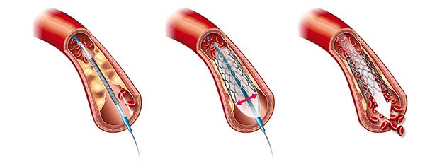 Peripheral arterial disease: Angioplasty - Stenting