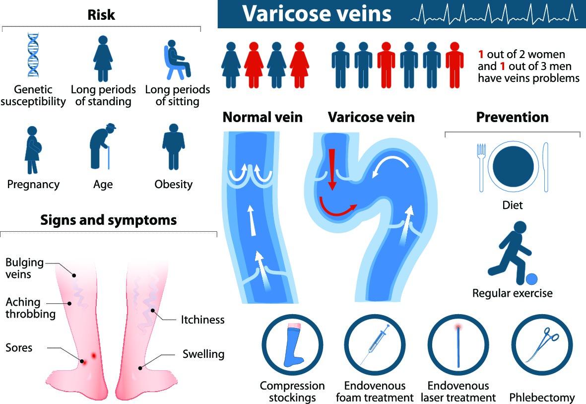 Venous Insufficiency Varicose Veins