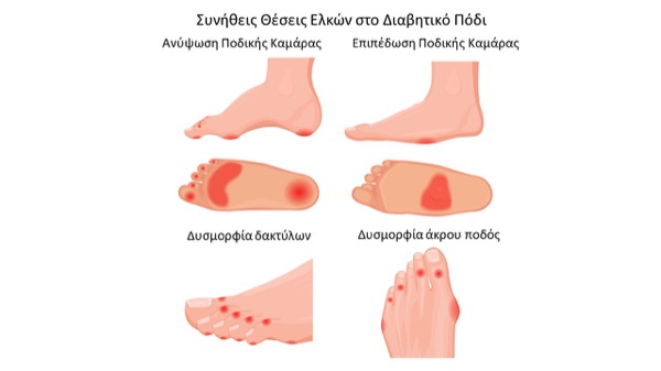 What is the Diabetic Foot